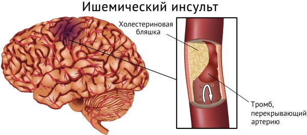 Рибоксин. Инструкция, показания к применению внутривенно, состав, противопоказания