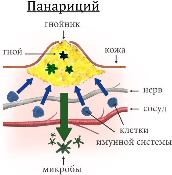 «Фукорцин» – эффективный препарат от грибка ногтей. Инструкция применения. Отзывы