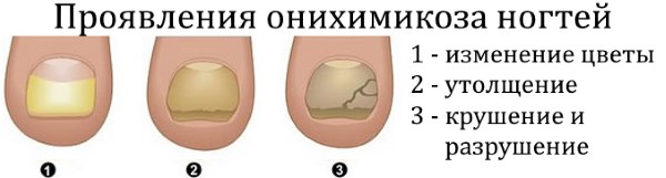 «Фукорцин» – эффективный препарат от грибка ногтей. Инструкция применения. Отзывы