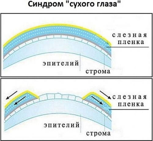 Глазные капли от сухости и усталости глаз. Список увлажняющих лечебных средств