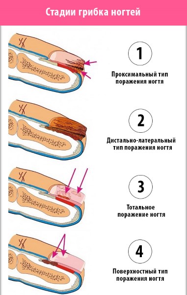 «Номидол» – лучшее средство от грибка ногтей. Развод или правда: его полезные свойства