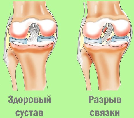 Причины и лечение боли в коленном суставе с внутренней стороны. Как устранить боль в колене