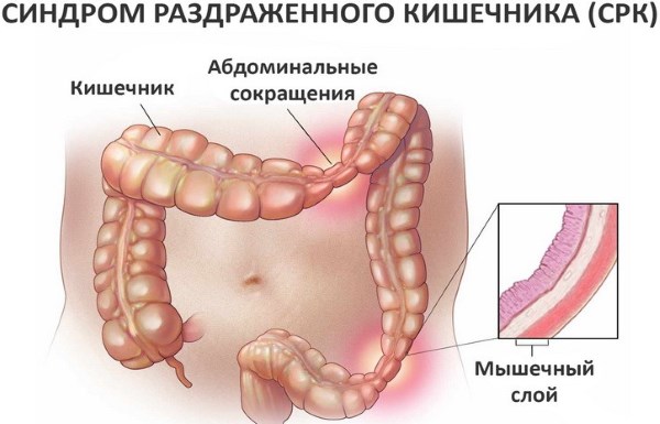 Причины и лечение кишечника при вздутии живота после еды. Симптомы заболеваний органов ЖКТ