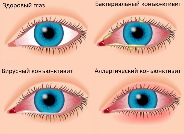 Правый глаз лежал в стакане остальное на диване