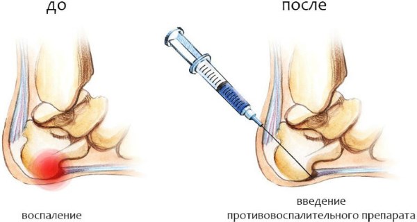 Шпоры на пятках. Причины и лечение медикаментами, народными средствами, ультрозвук, лазеротерапия