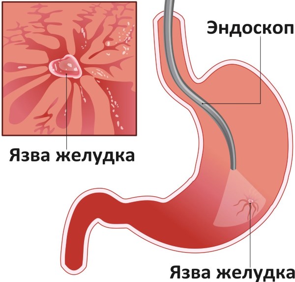 Препараты от изжоги. Список эффективных средств лечения изжоги, как .