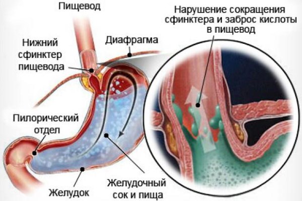 Список препаратов от изжоги. Инструкции, особенности применения, противопоказания, цены