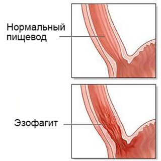 Изжога. Причины, методы и средства лечения. Последствия игнорирования жжения в пищеводе