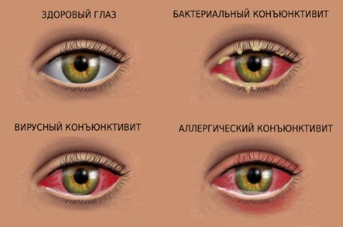 Лечение воспаления и покраснения глаз. Народные средства и лекарства из аптеки