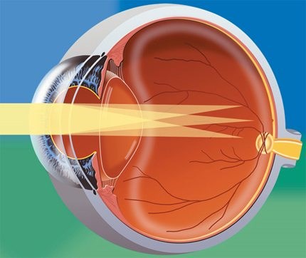 Астигматизм - что это такое, причины, лечение у детей, взрослых лазером, народными средствами дома