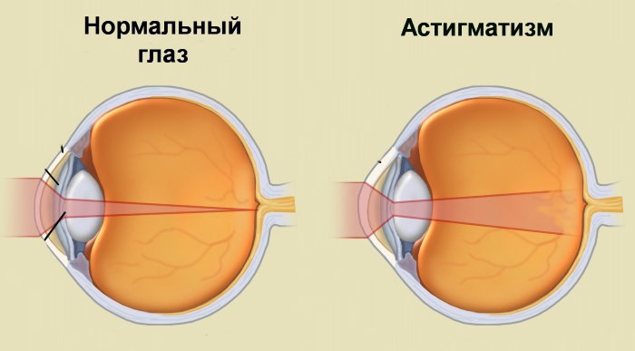 Астигматизм - что это такое, причины, лечение у детей, взрослых лазером, народными средствами дома