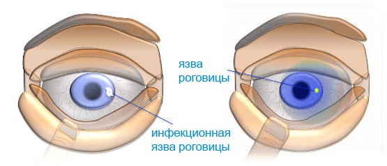 Бактериальный конъюнктивит глаз. Симптомы, лечение у детей, капли