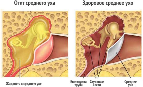 Боль в ухе при глотании, жевании, с одной стороны, после купания. Как лечить в домашних условиях