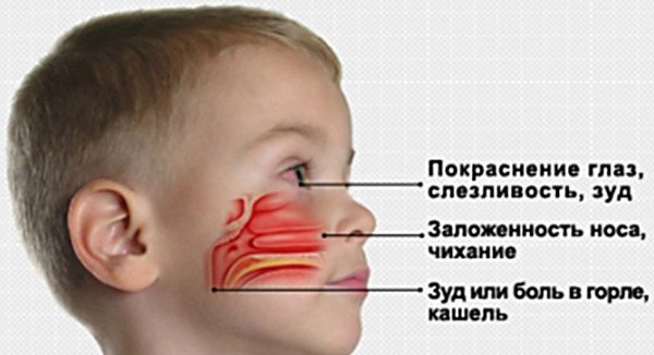 Чем лечить покраснение глаз в домашних условиях. Примочки, компрессы, капли