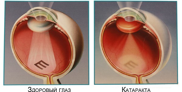 Катаракта глаза. Симптомы болезни, лечение народными средствами, операция