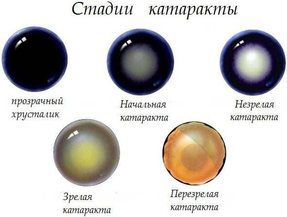 Катаракта глаза. Симптомы болезни, лечение народными средствами, операция