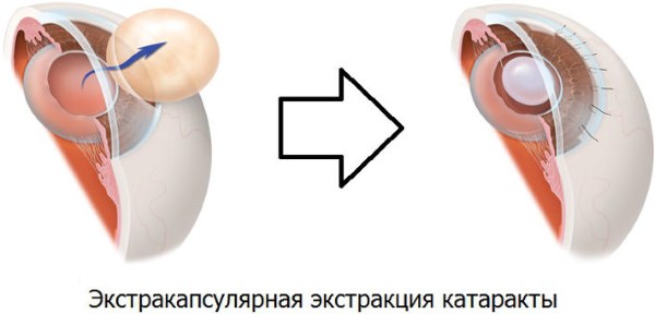 Катаракта глаза. Симптомы болезни, лечение народными средствами, операция