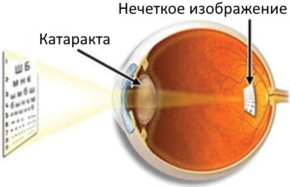 Катаракта глаза. Симптомы болезни, лечение народными средствами, операция