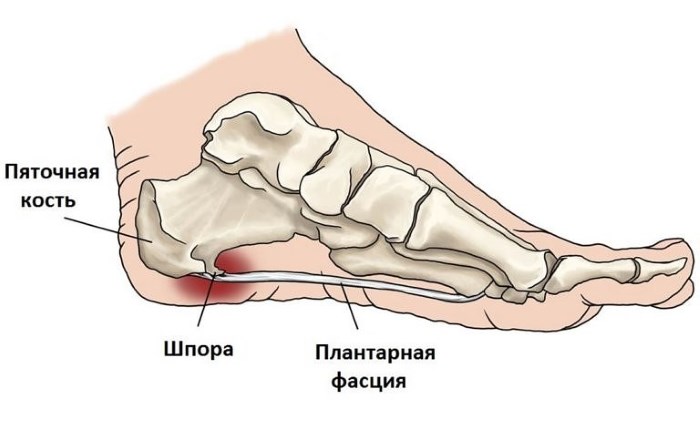 Причины боли в пятках ног при ходьбе, больно наступать. Как лечить, народные средства