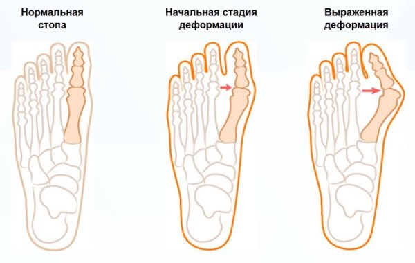 Причины боли в пятках ног при ходьбе, больно наступать. Как лечить, народные средства