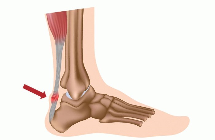 Причины боли в пятках ног при ходьбе, больно наступать. Как лечить, народные средства