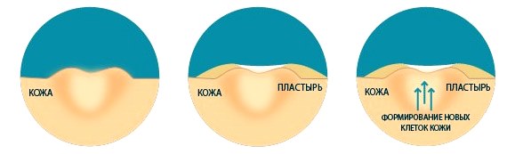 Салипод – пластырь от мозолей, бородавок. Инструкция, показания к применению