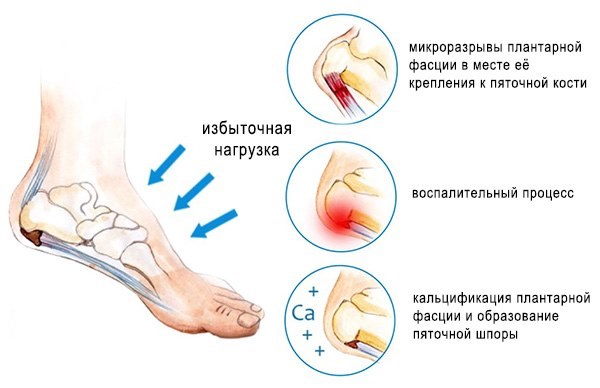 Шпоры на пятках. Быстрое медикаментозное лечение, народные средства, йод