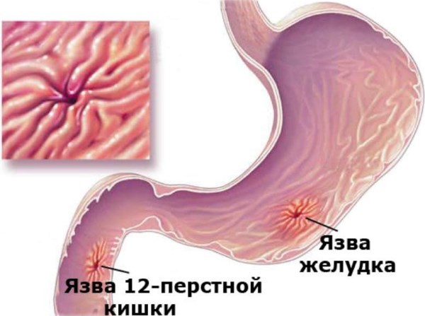 Симптомы, первые признаки язвы желудка на ранней стадии у взрослых женщин и мужчин