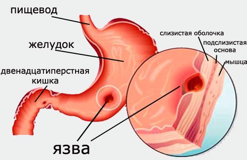 Симптомы язвы желудка на ранней стадии у женщин, мужчин, детей