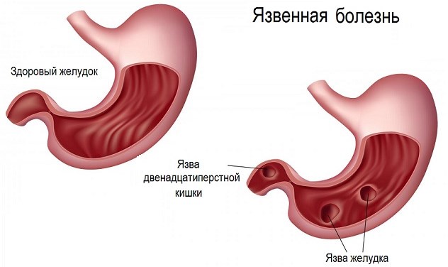 Симптомы язвы желудка на ранней стадии у женщин, мужчин, детей