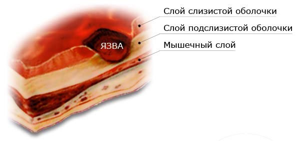 Симптомы язвы желудка на ранней стадии у женщин, мужчин, детей