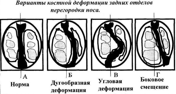 Храп у женщин - апноэ. Причины и лечение при беременности. Народные средства, лазер