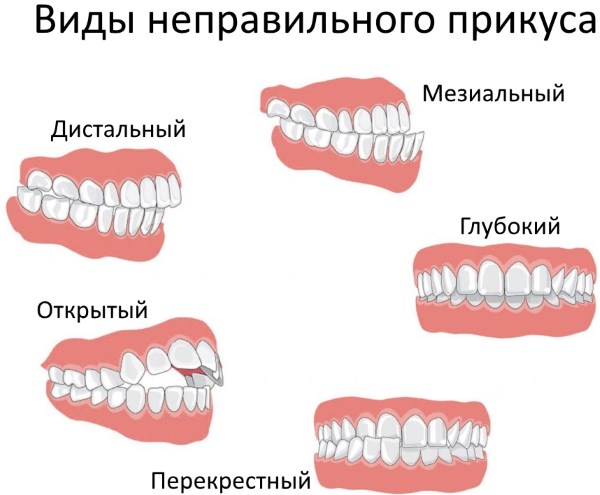 Храп у женщин - апноэ. Причины и лечение при беременности. Народные средства, лазер