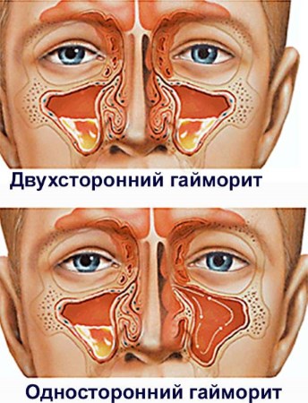 Храп у женщин - апноэ. Причины и лечение при беременности. Народные средства, лазер