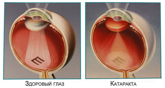 Замена хрусталика при катаракте глаза. Послеоперационный период, отзывы