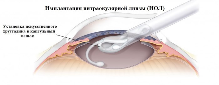 Замена хрусталика при катаракте глаза. Послеоперационный период, отзывы