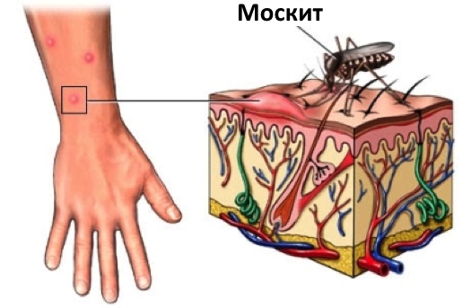 Аллергия у ребенка – симптомы и лечение