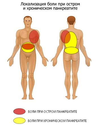 Боль в поджелудочной железе. Признаки, симптомы воспаления. Как лечить поджелудочную