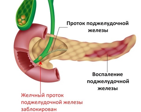 Боль в поджелудочной железе. Признаки, симптомы воспаления. Как лечить поджелудочную