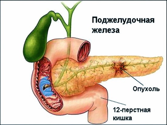 Боль в поджелудочной железе. Признаки, симптомы воспаления. Как лечить поджелудочную