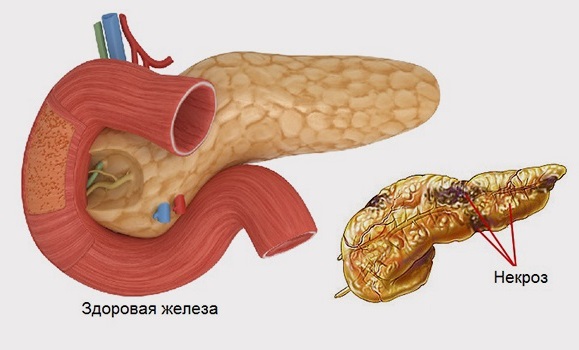 Боль в поджелудочной железе. Признаки, симптомы воспаления. Как лечить поджелудочную