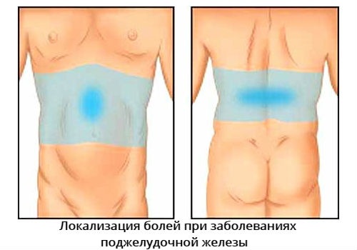 Боль в поджелудочной железе. Признаки, симптомы воспаления. Как лечить поджелудочную