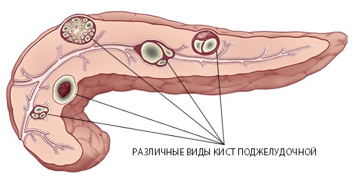 Боль в поджелудочной железе. Признаки, симптомы воспаления. Как лечить поджелудочную