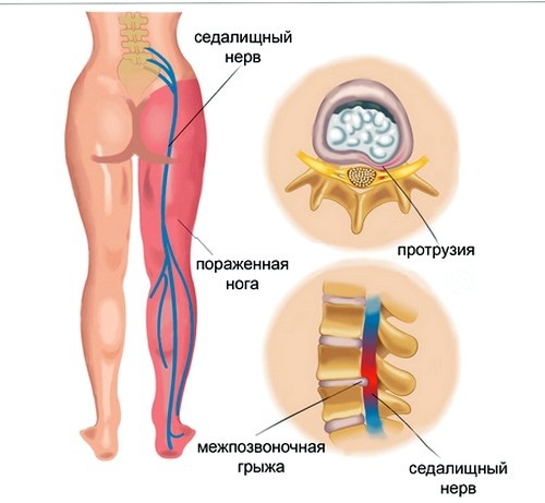 Боль в пояснице – причины и лечение