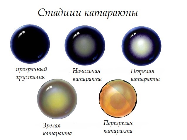 Глаукома и катаракта одновременно, что лучше: лечение или операция. Народные средства