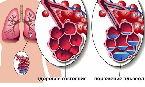 Горчичники при кашле. Как ставить, куда, инструкция взрослым и детям