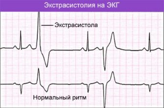 Холтер на сердце для чего фото