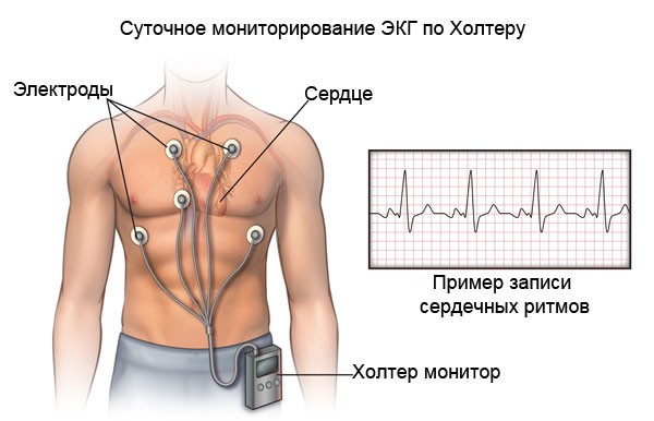 Что такое холтер сердца, как делают мониторинг, фото, видео, цена