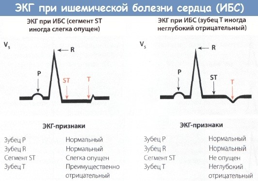 Что такое холтер сердца, как делают мониторинг, фото, видео, цена