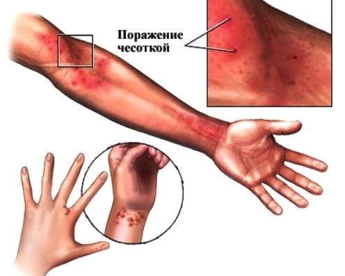 Красные пятна на коже. Аллергия, лишай или ещё что-то? Почему они чешутся. Причины аллергии